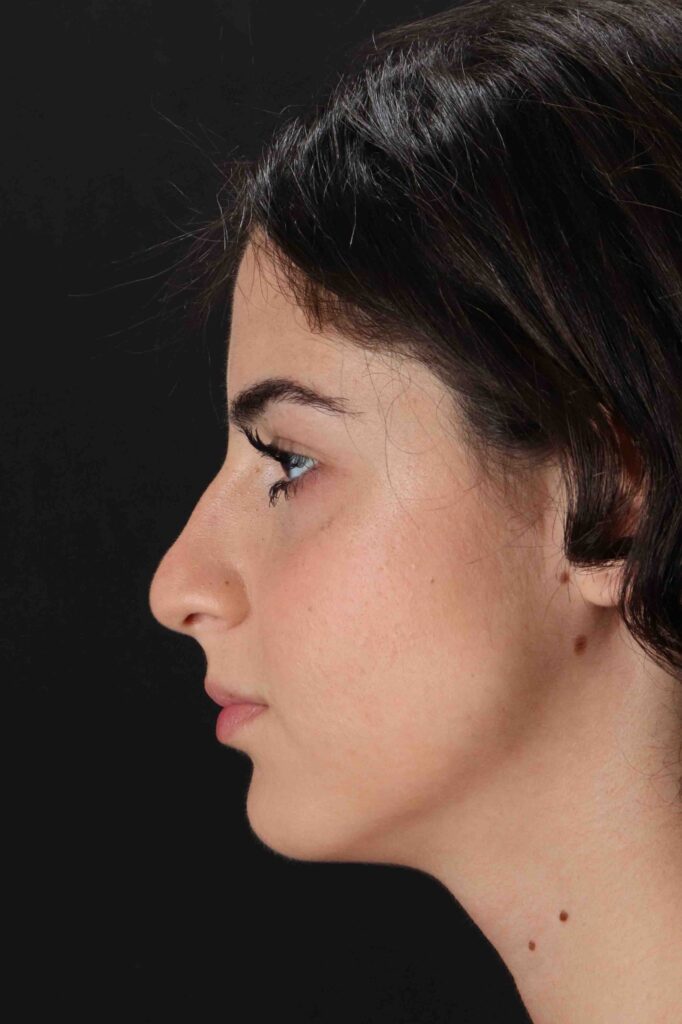 Before - left_lateral