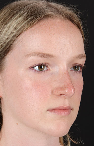 After - right_oblique