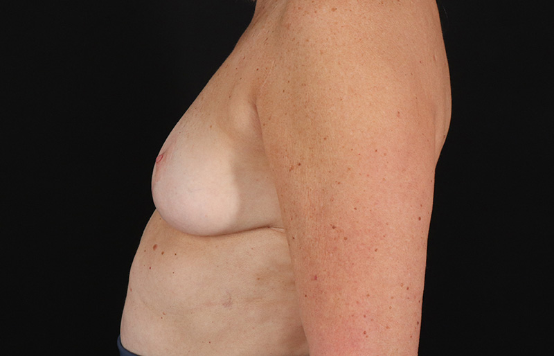 After - left_lateral