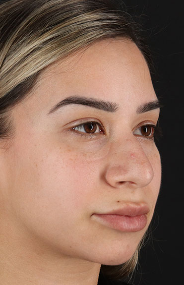 Before - right_oblique