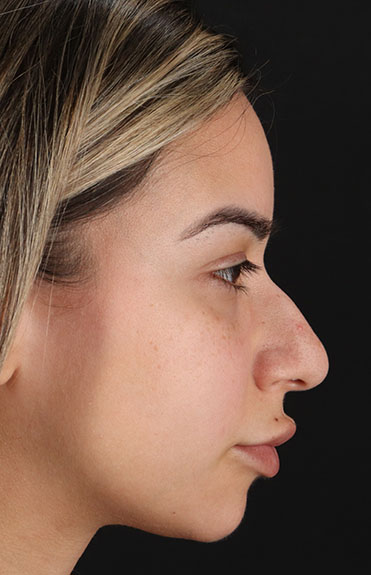 Before - right_lateral