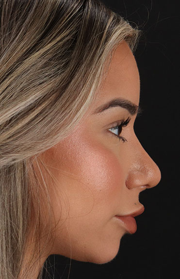 After - right_lateral