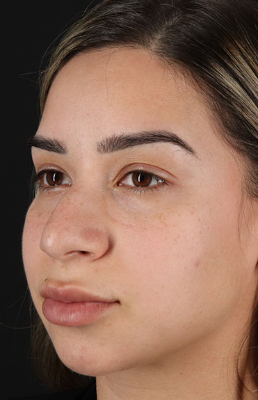 Before - left_oblique