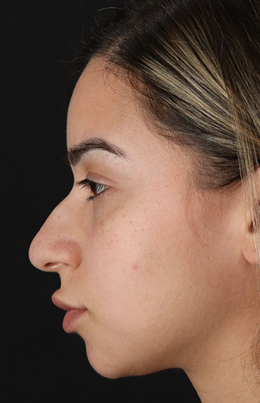 Before - left_lateral