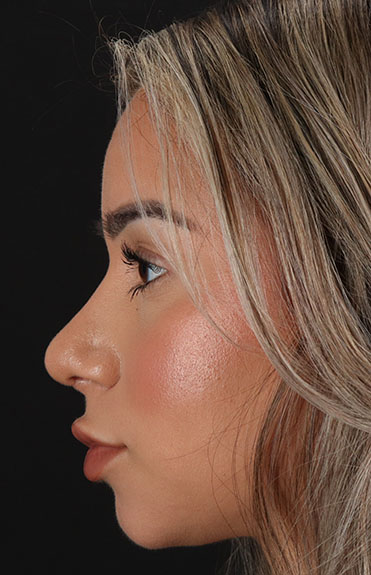 After - left_lateral