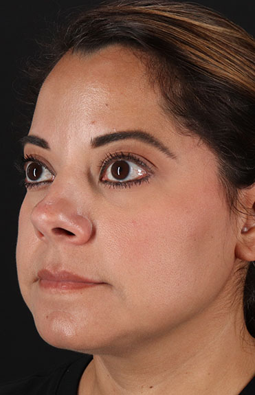 After - left_oblique