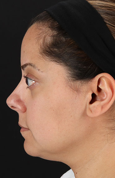 Before - left_lateral