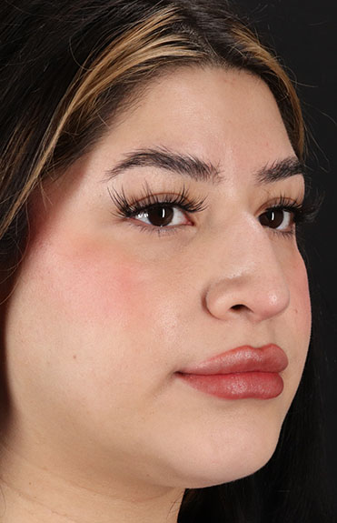 Before - right_oblique