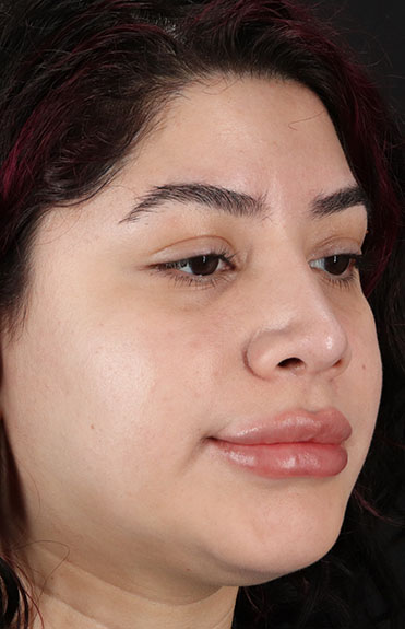 After - right_oblique