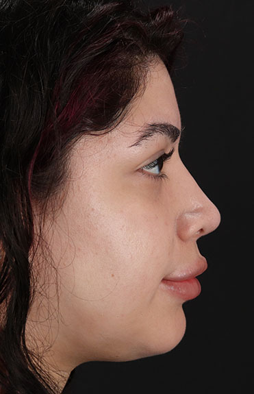 After - right_lateral