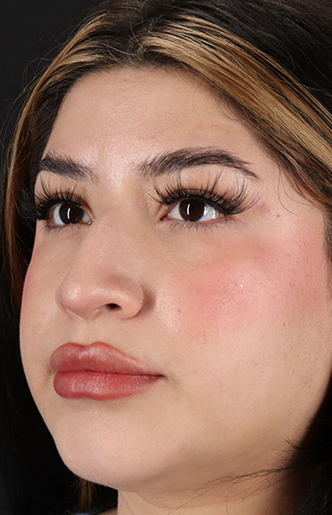 Before - left_oblique