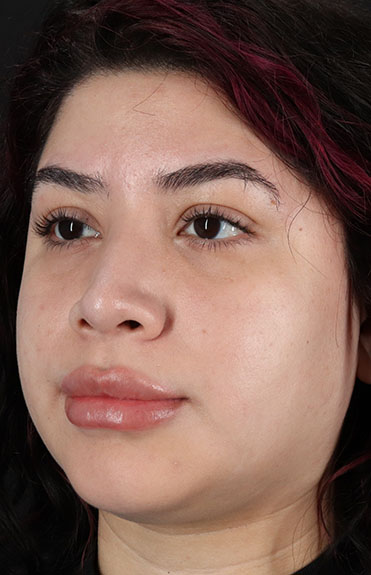 After - left_oblique