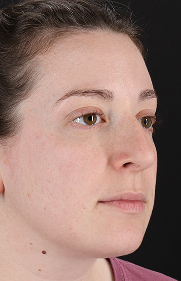 Before - right_oblique