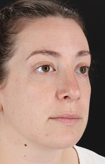 After - right_oblique