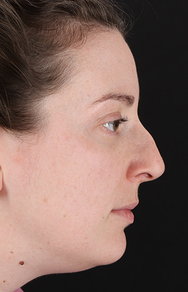 Before - right_lateral