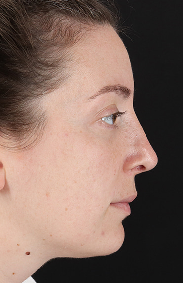 After - right_lateral