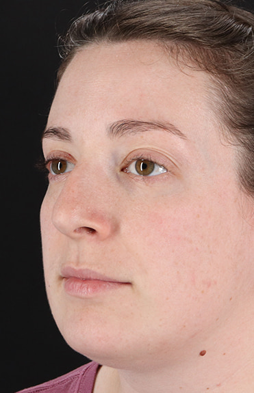 Before - left_oblique