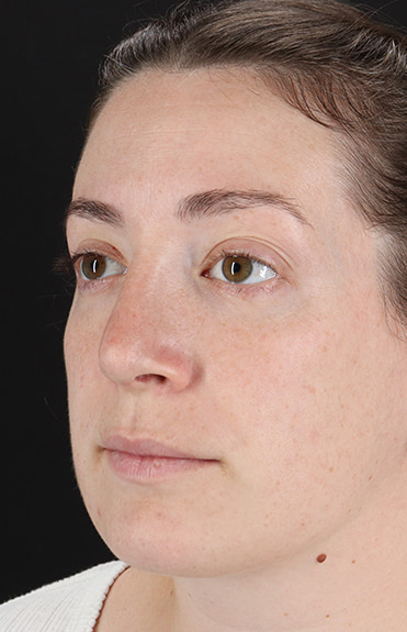 After - left_oblique