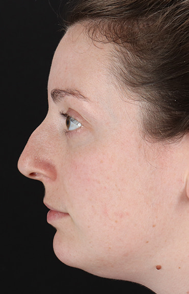 Before - left_lateral