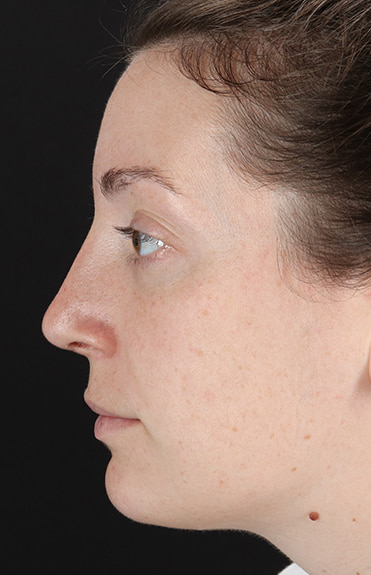 After - left_lateral