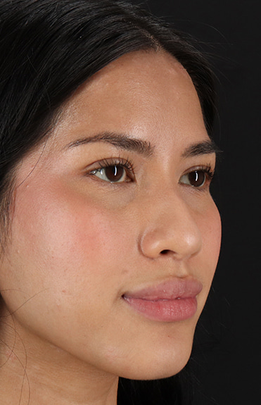 Before - right_oblique