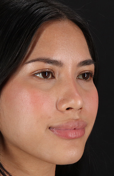 After - right_oblique