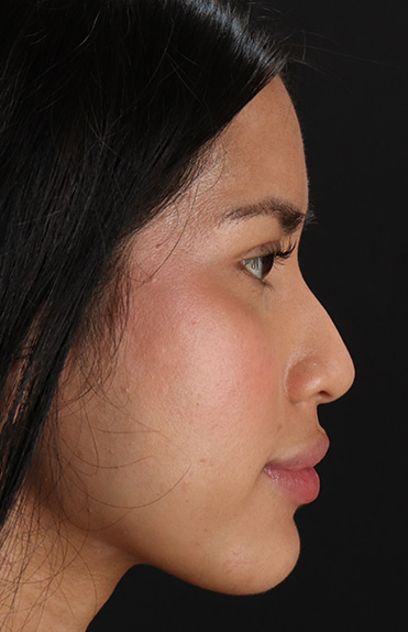 Before - right_lateral