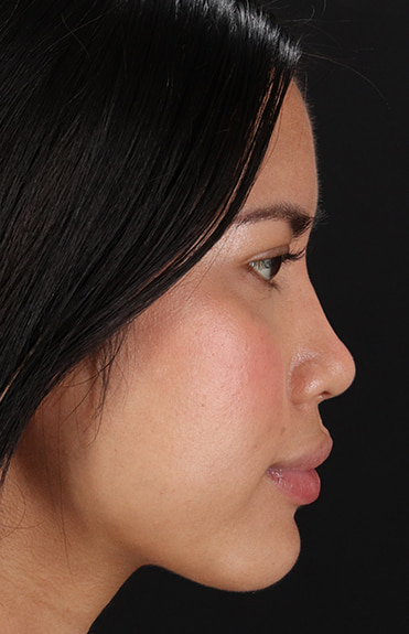 After - right_lateral