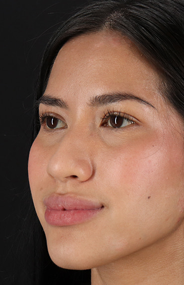 Before - left_oblique