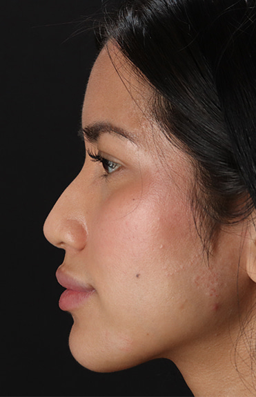 Before - left_lateral