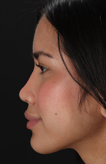 After - left_lateral