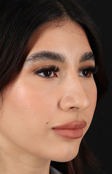 Before - right_oblique