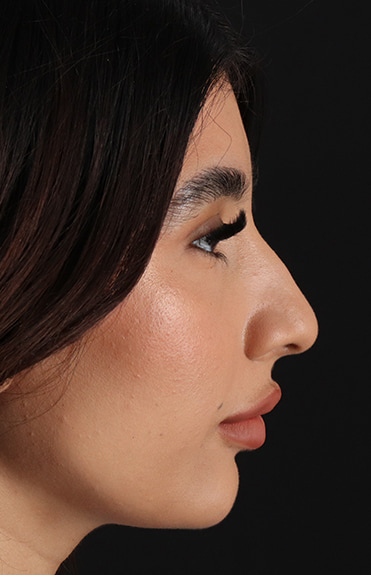 Before - right_lateral