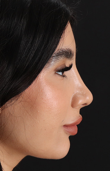 After - right_lateral