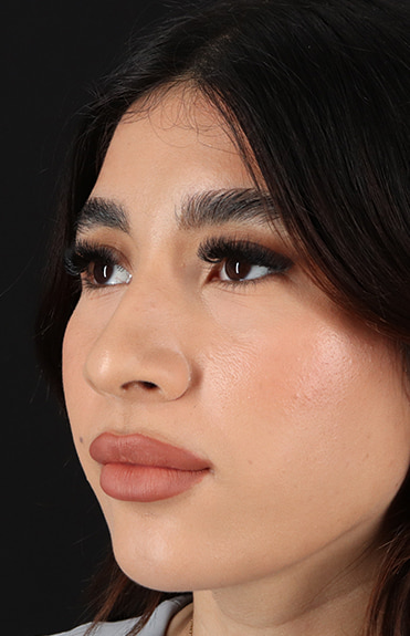 Before - left_oblique