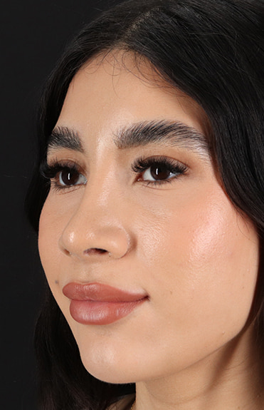 After - left_oblique