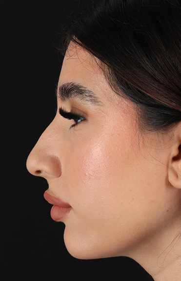 Before - left_lateral