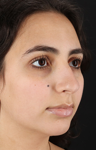 Before - right_oblique