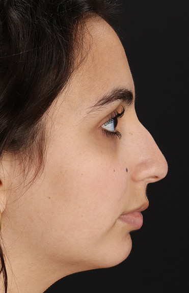 Before - right_lateral