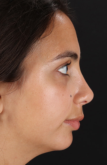 After - right_lateral