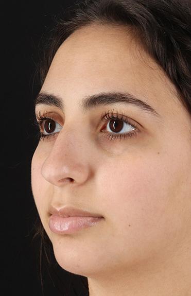 Before - left_oblique