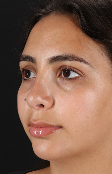 After - left_oblique