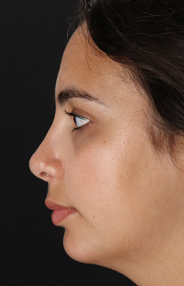 After - left_lateral