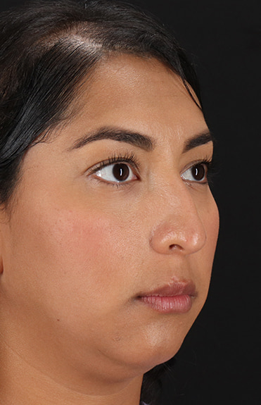 Before - right_oblique