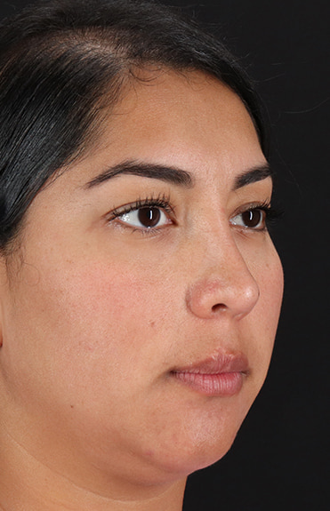 After - right_oblique