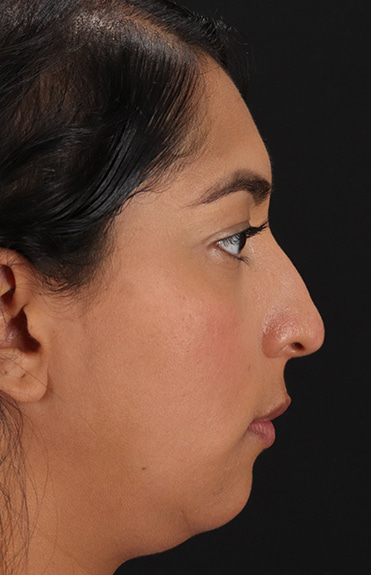 Before - right_lateral