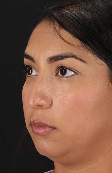 Before - left_oblique