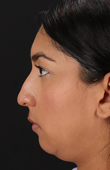 Before - left_lateral