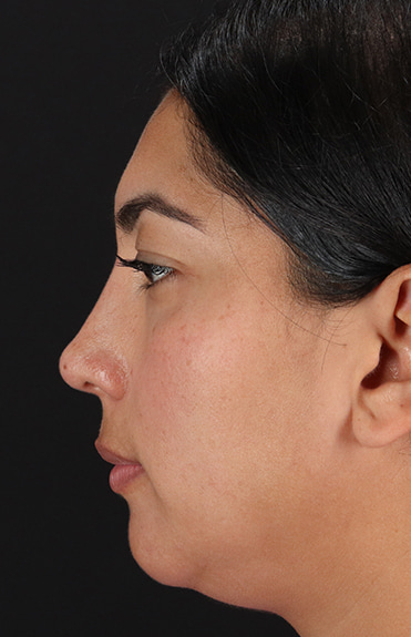 After - left_lateral