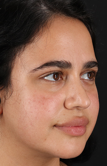 Before - right_oblique